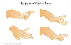 Cerebral Palsy Hand Deformity