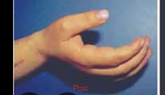 Cerebral Palsy Hand Deformity — after
