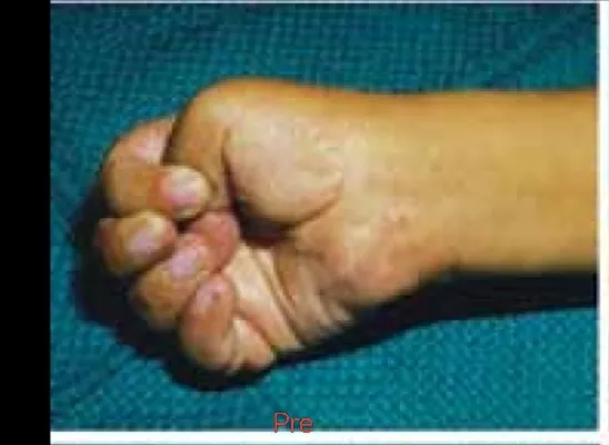 Cerebral Palsy Hand Deformity — before