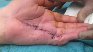 Dupuytren S Contracture — after
