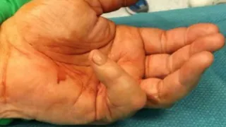 Dupuytren S Contracture — before