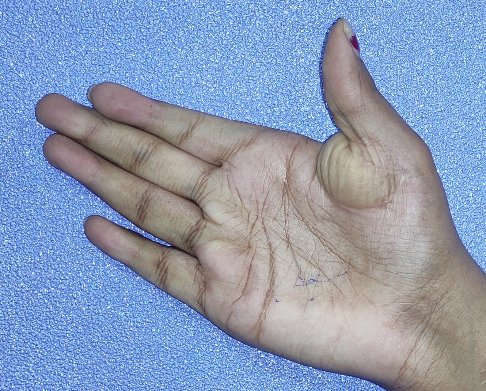 Camptodactyly — after