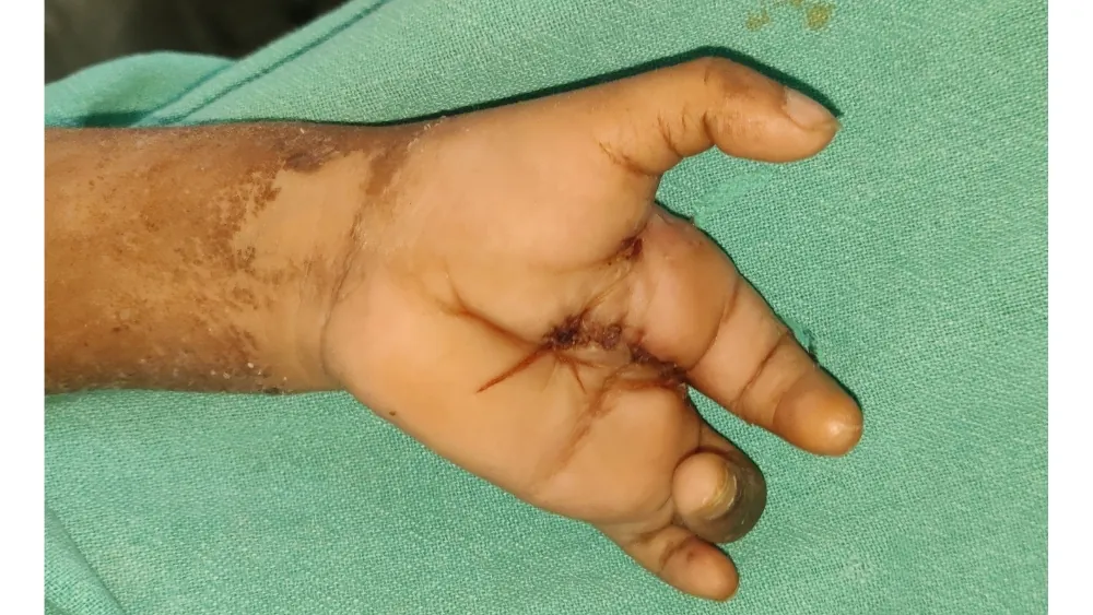 Cleft Hand Foot — after