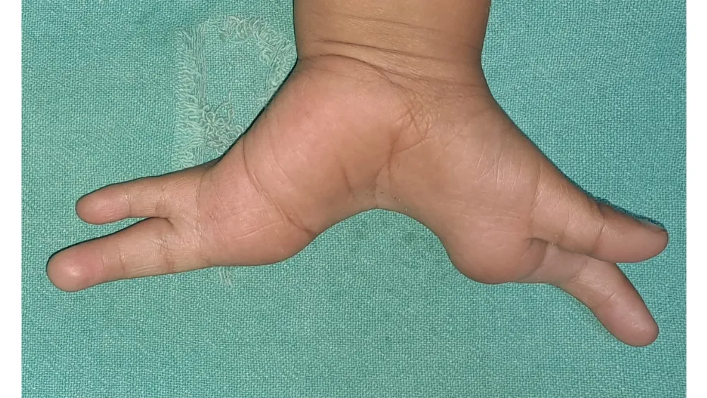 Cleft Hand Foot — before