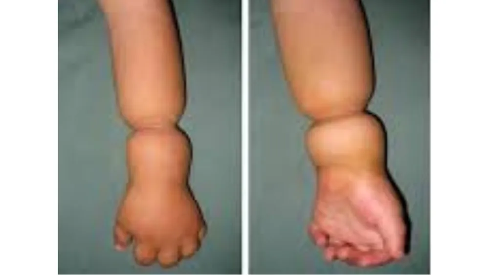 Constriction Ring Syndrome — before