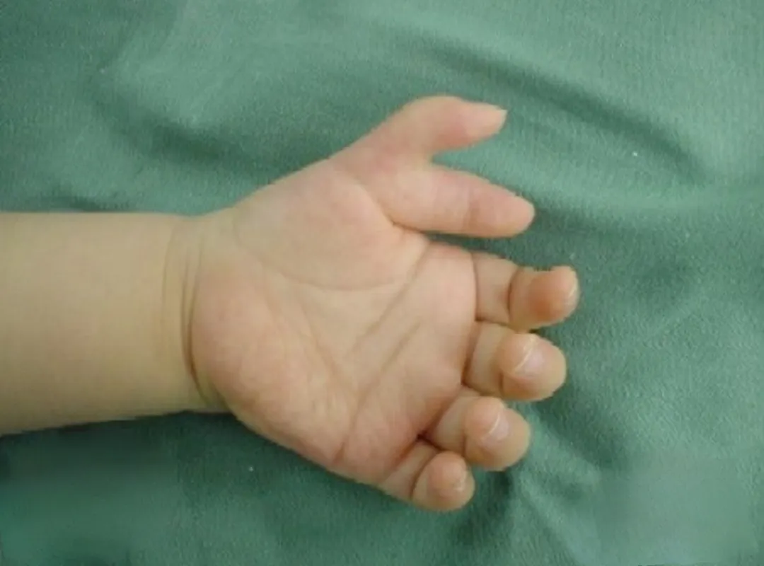 Polydactyly — before