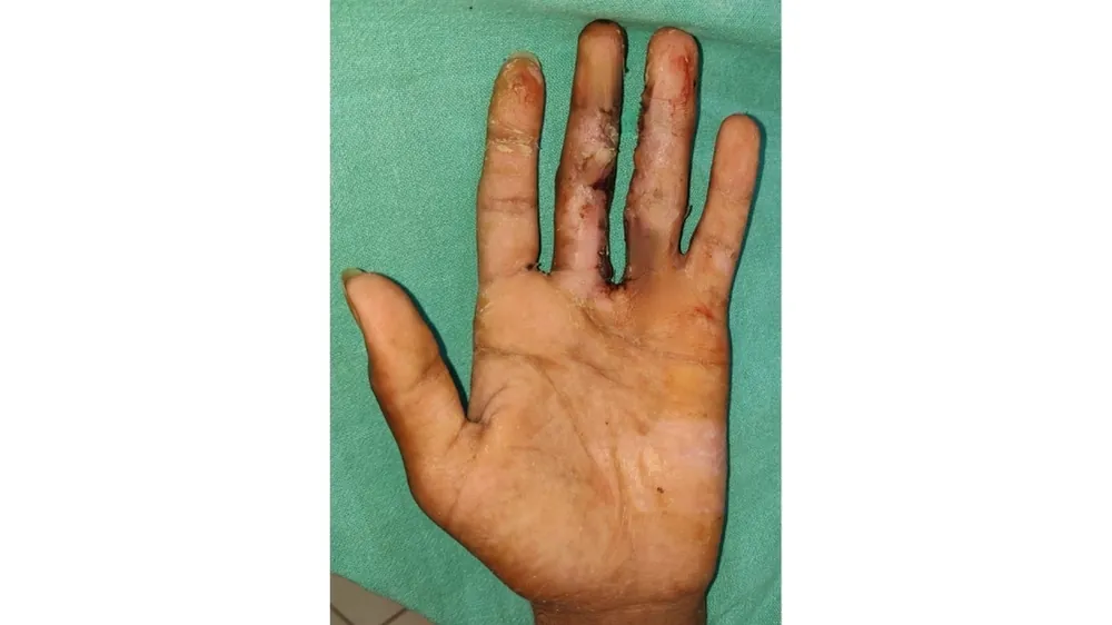 Syndactyly — after