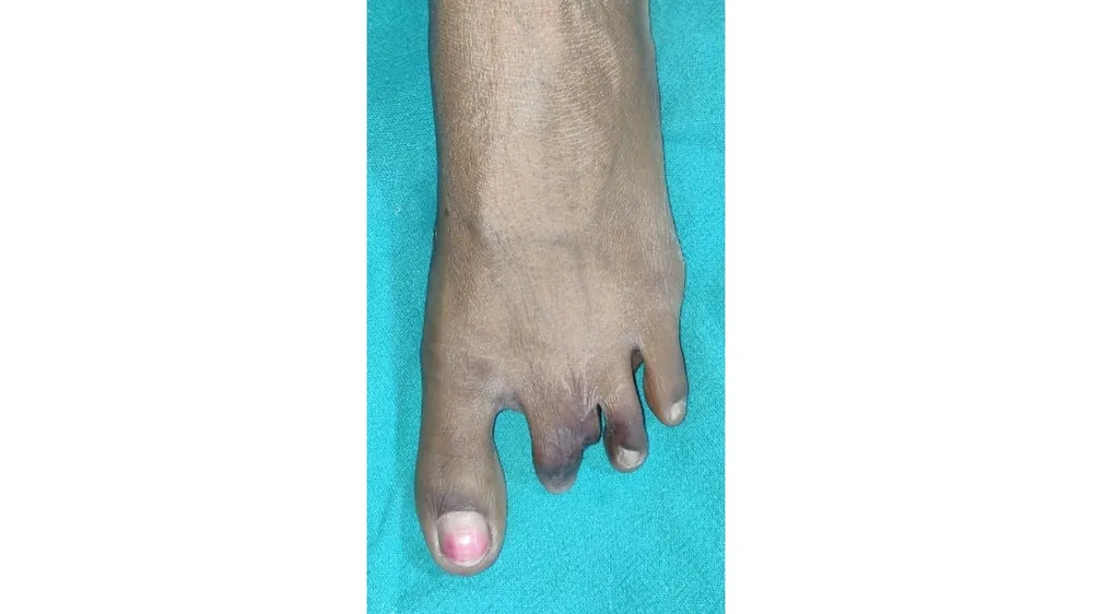 Syndactyly — before