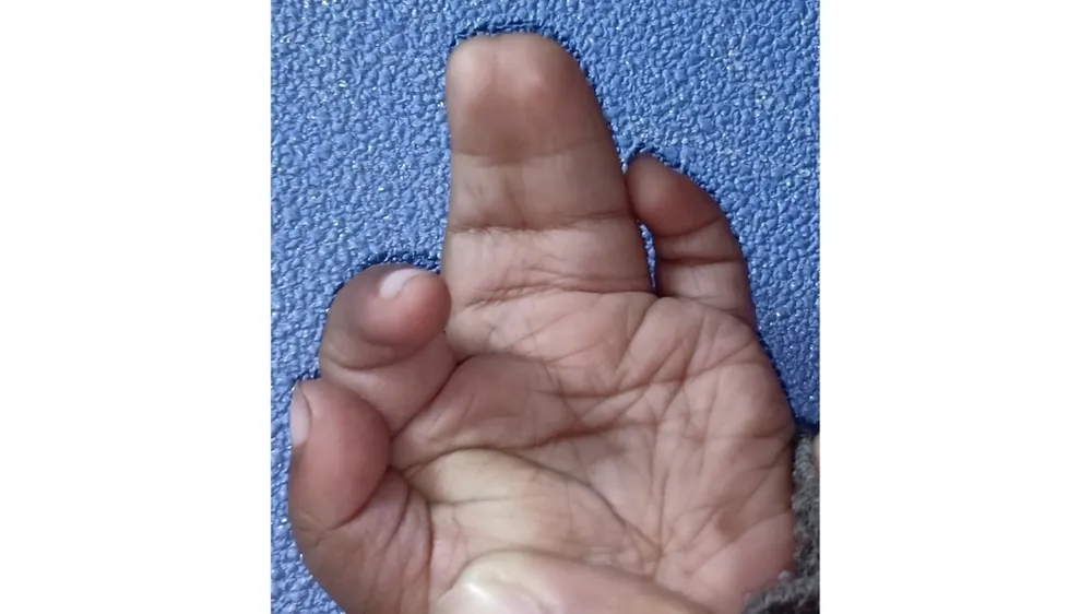 Syndactyly — before