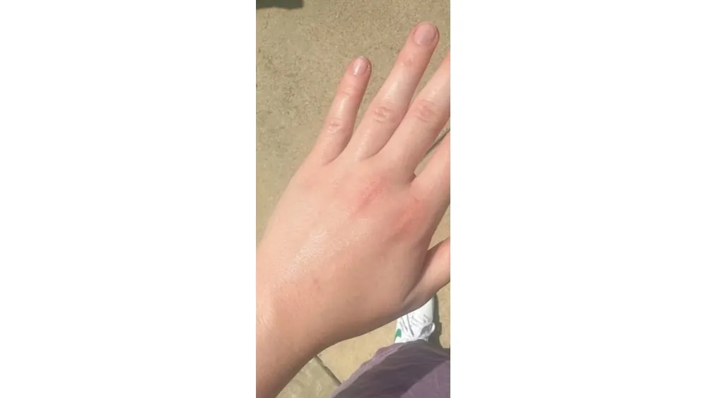 Hand Infections — after