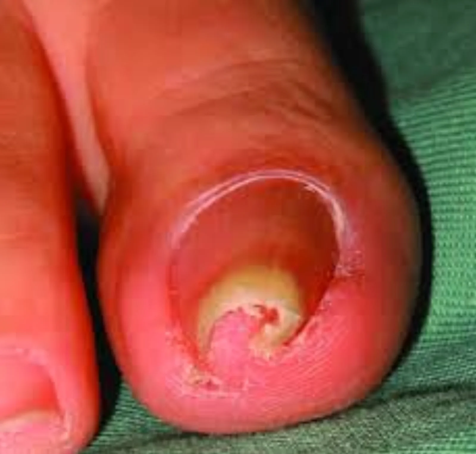 Nail Deformities — procedure visual