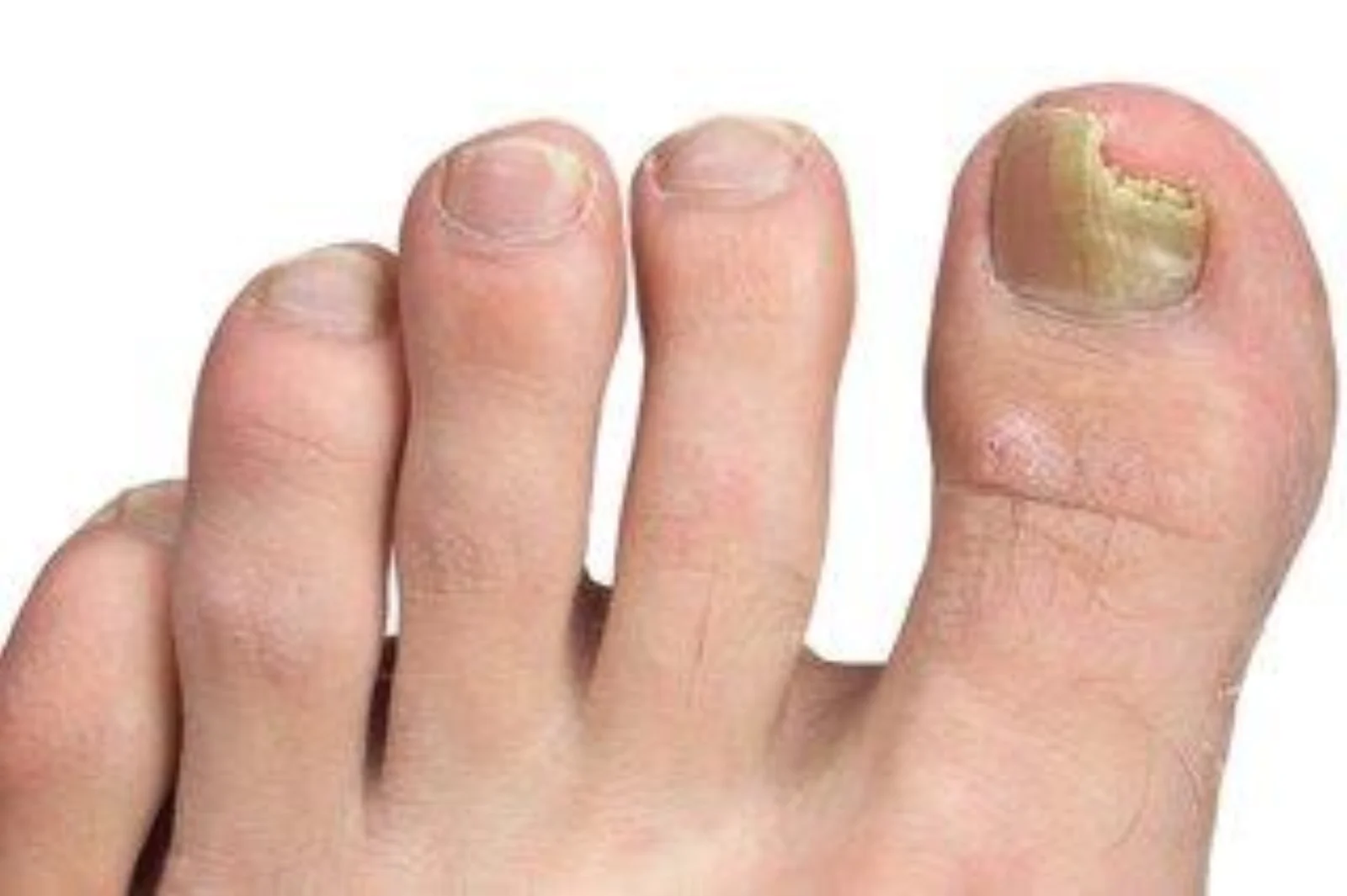 Nail Deformities — patient outcome