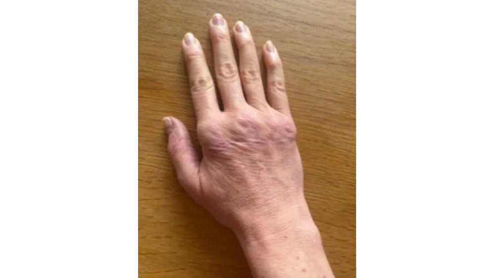 Stiff Hand — after