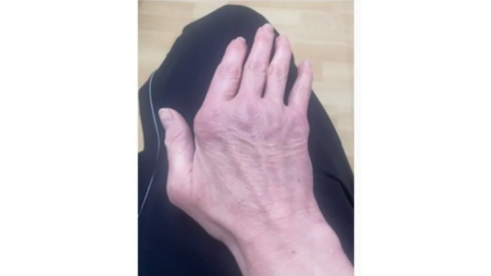 Stiff Hand — before
