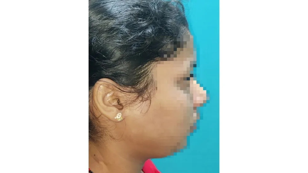 Jaw Disorders — before