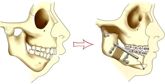 TMJ Ankylosis — hero image