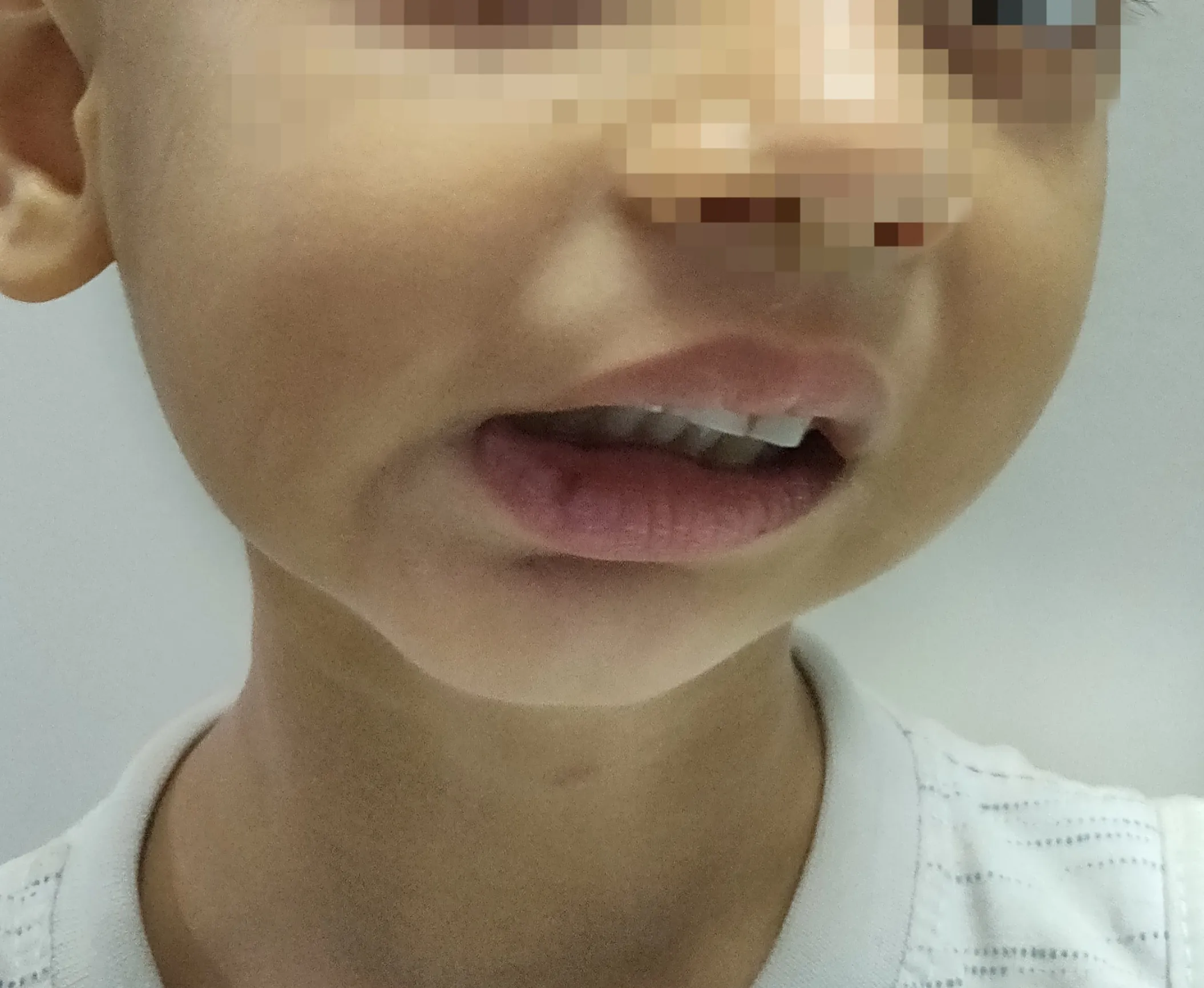 TMJ Ankylosis — before