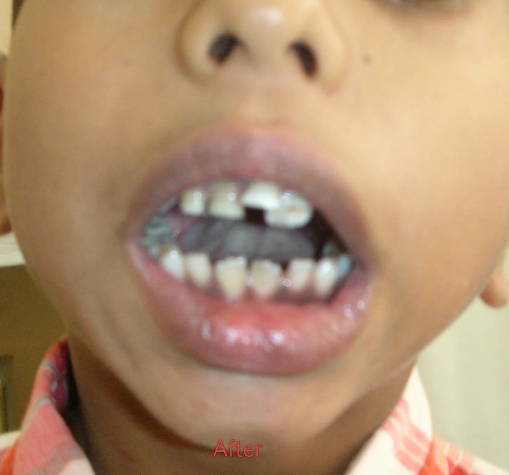 TMJ Ankylosis — after