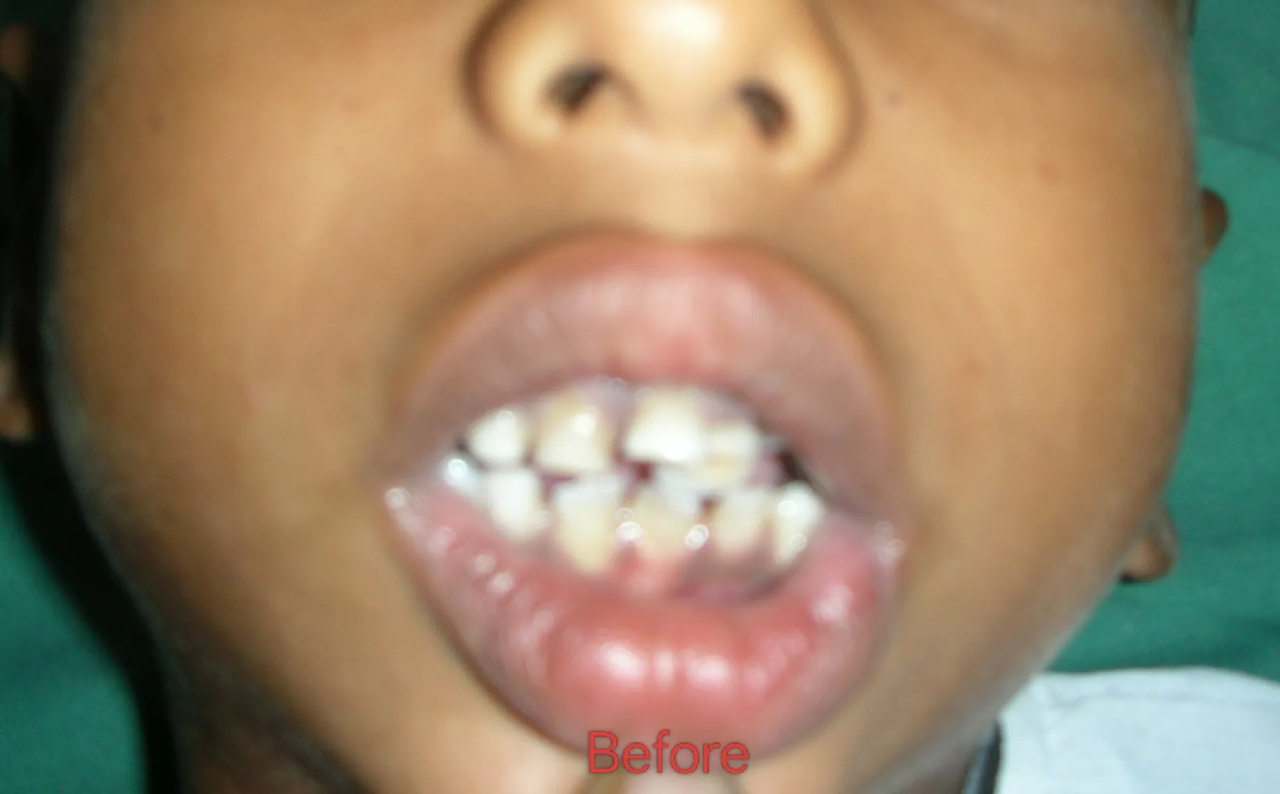 TMJ Ankylosis — before