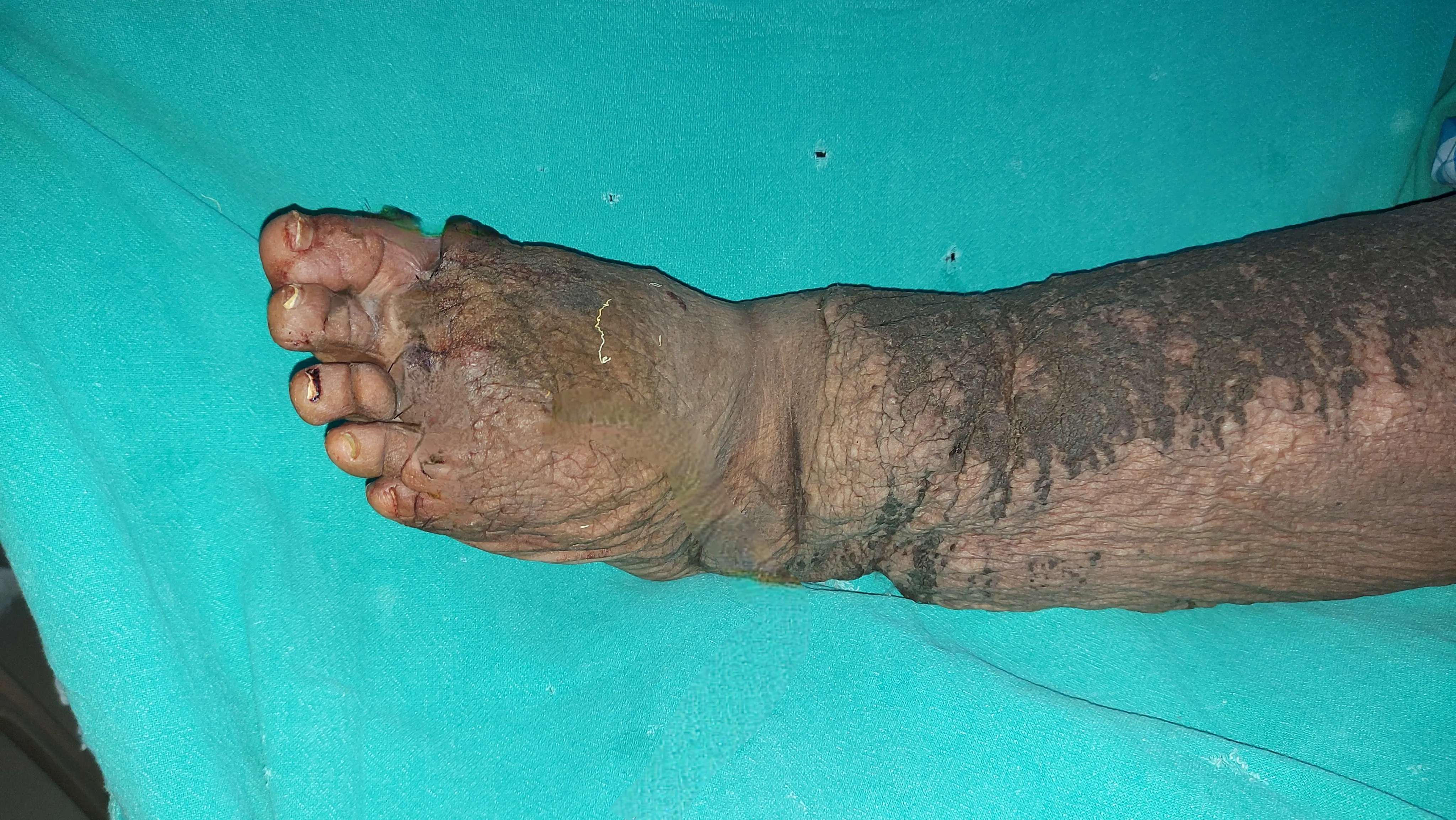 Filariasis — after