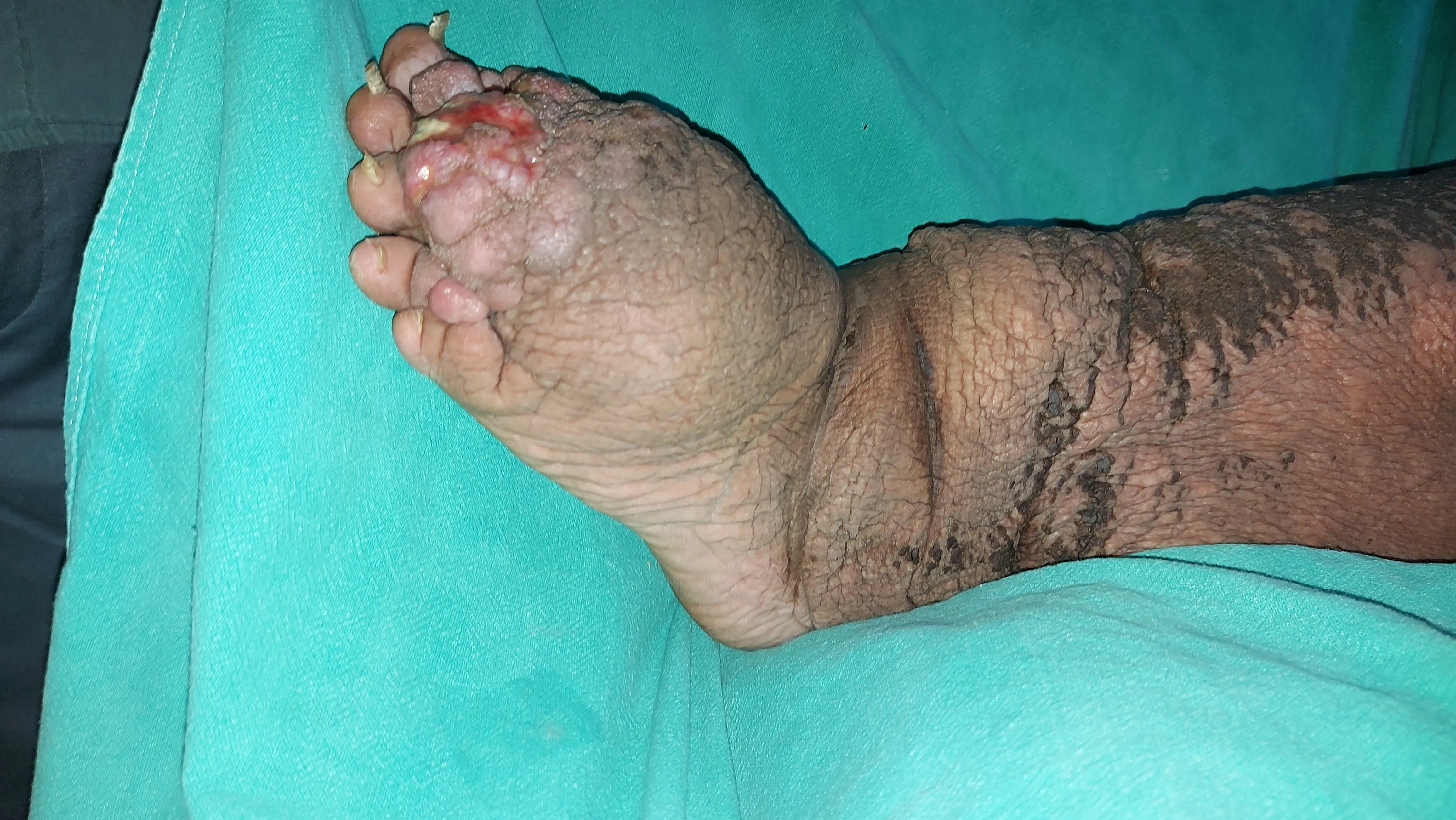 Filariasis — before