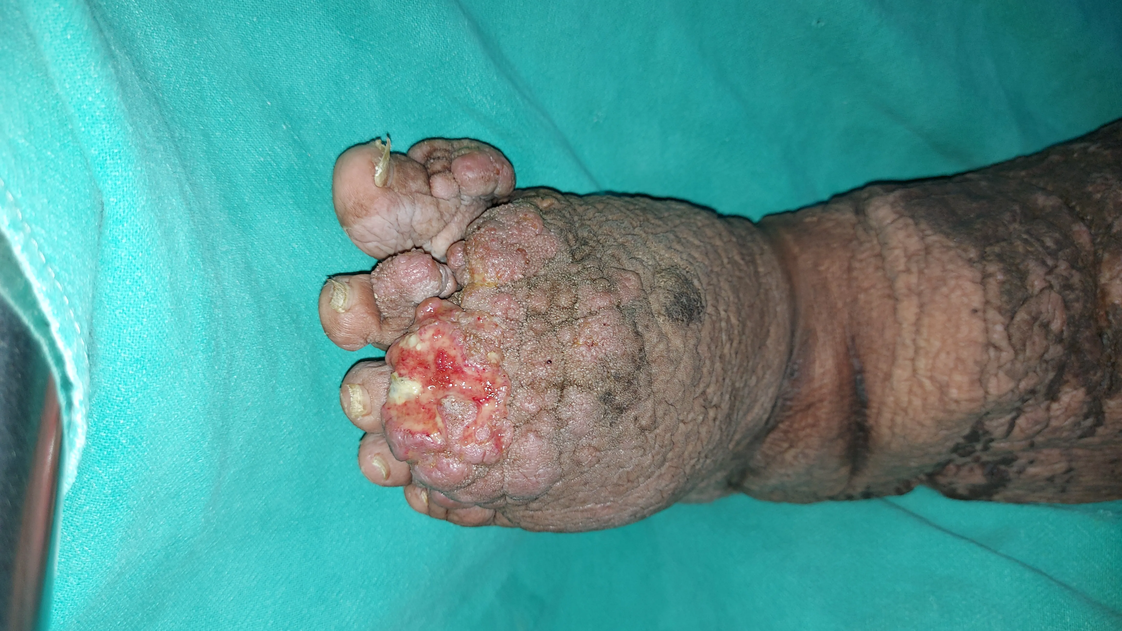 Filariasis — before