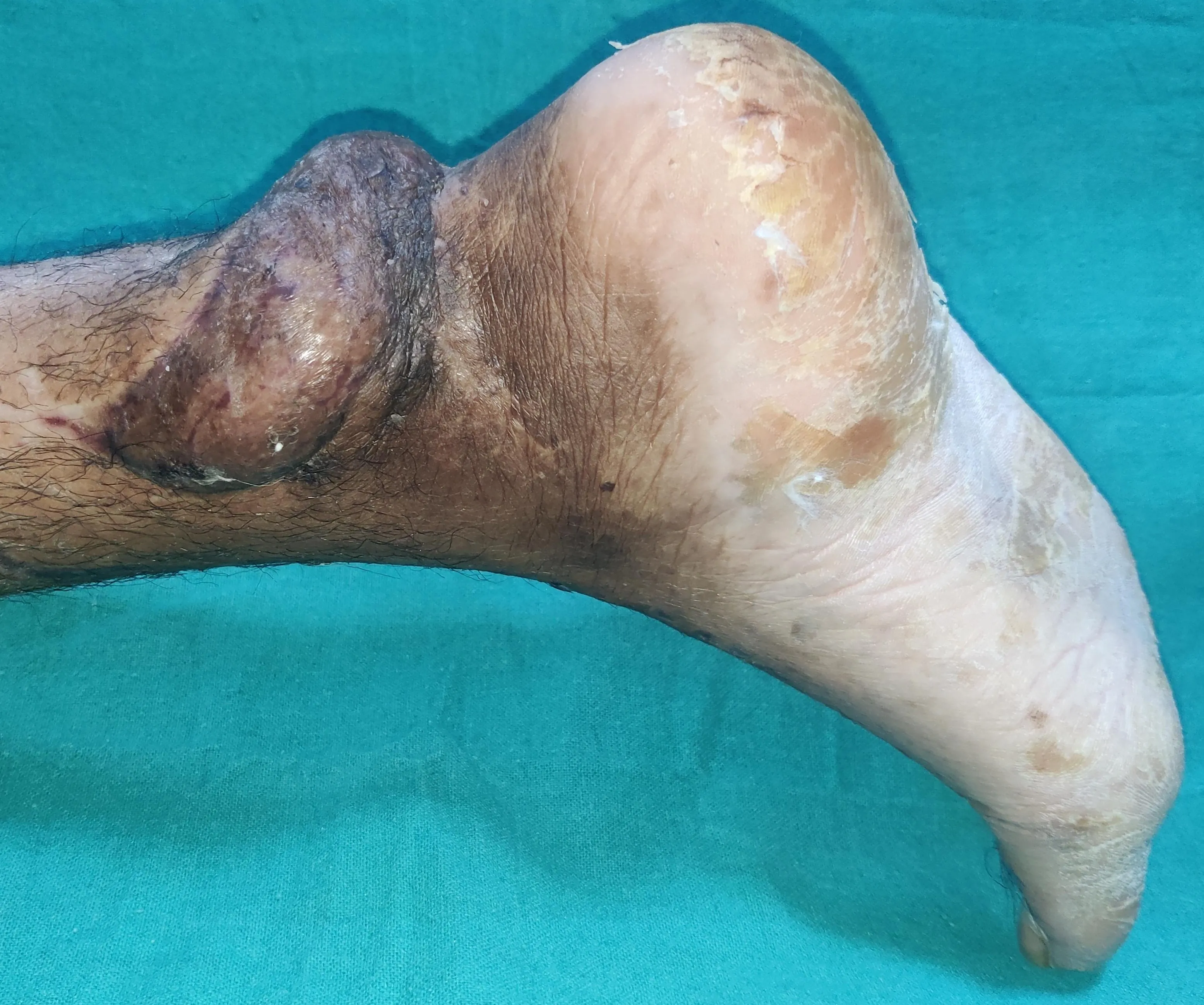 Microsurgical Free Flaps — after