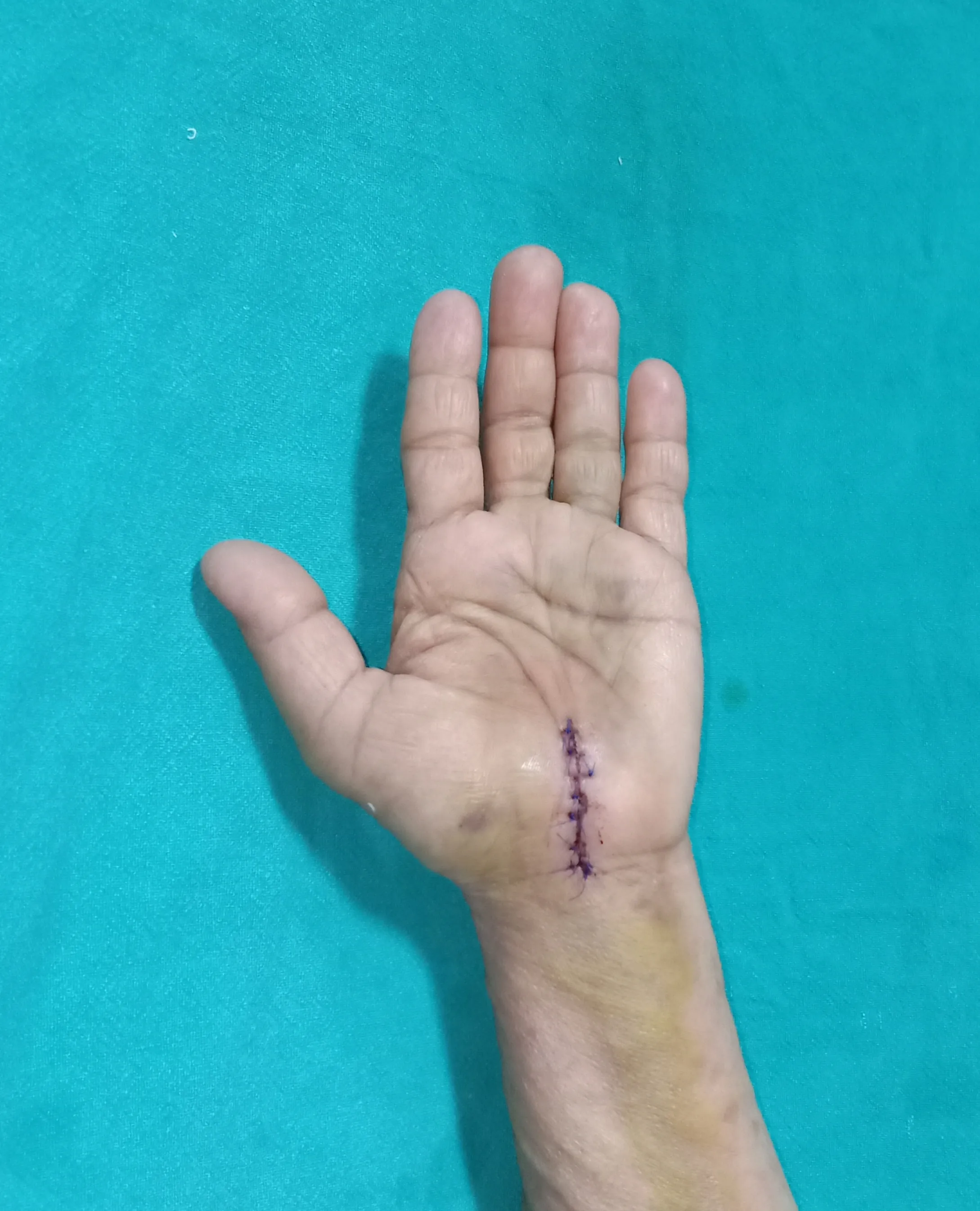 Carpal Tunnel Syndrome — after