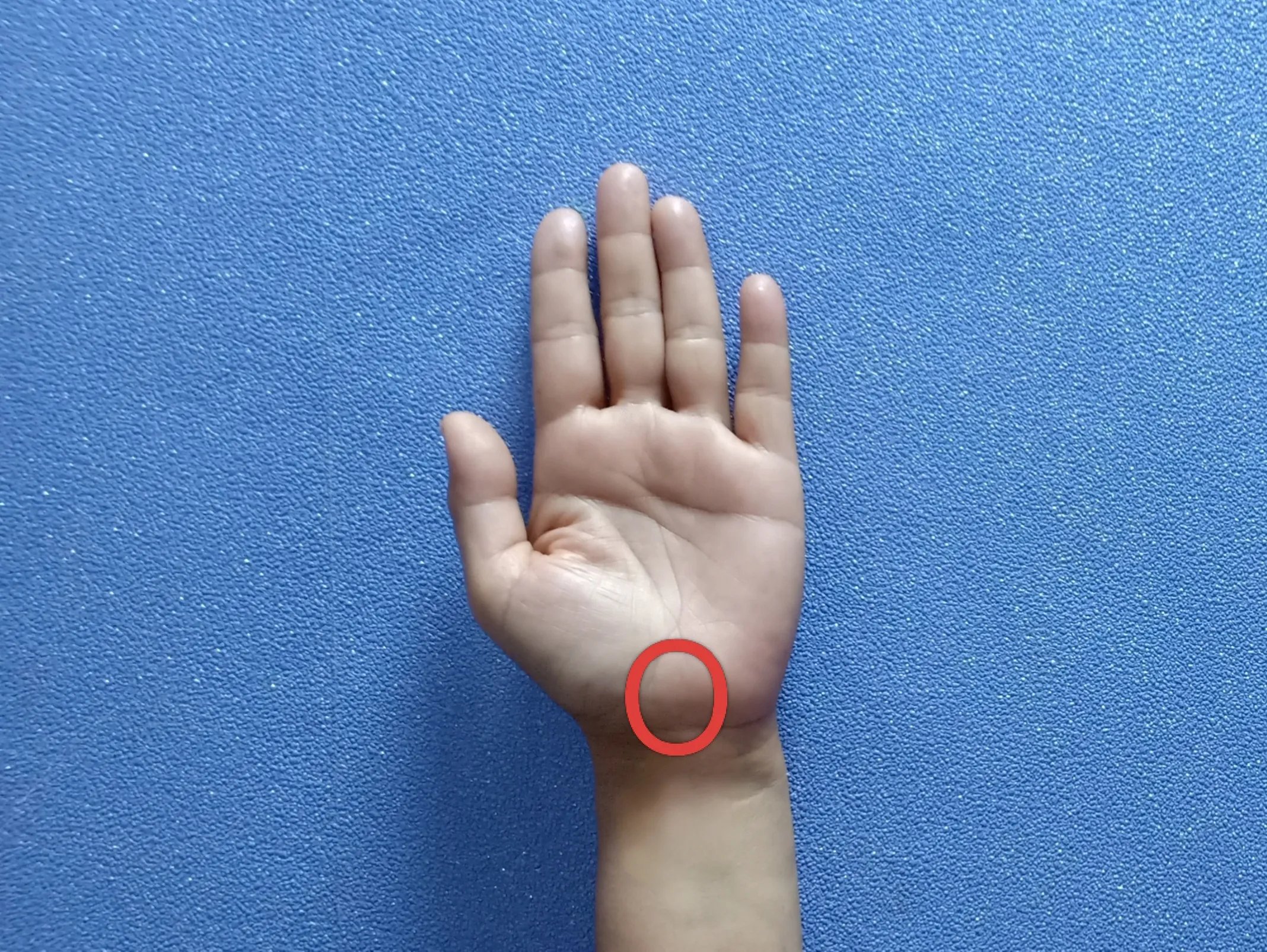 Carpal Tunnel Syndrome — before