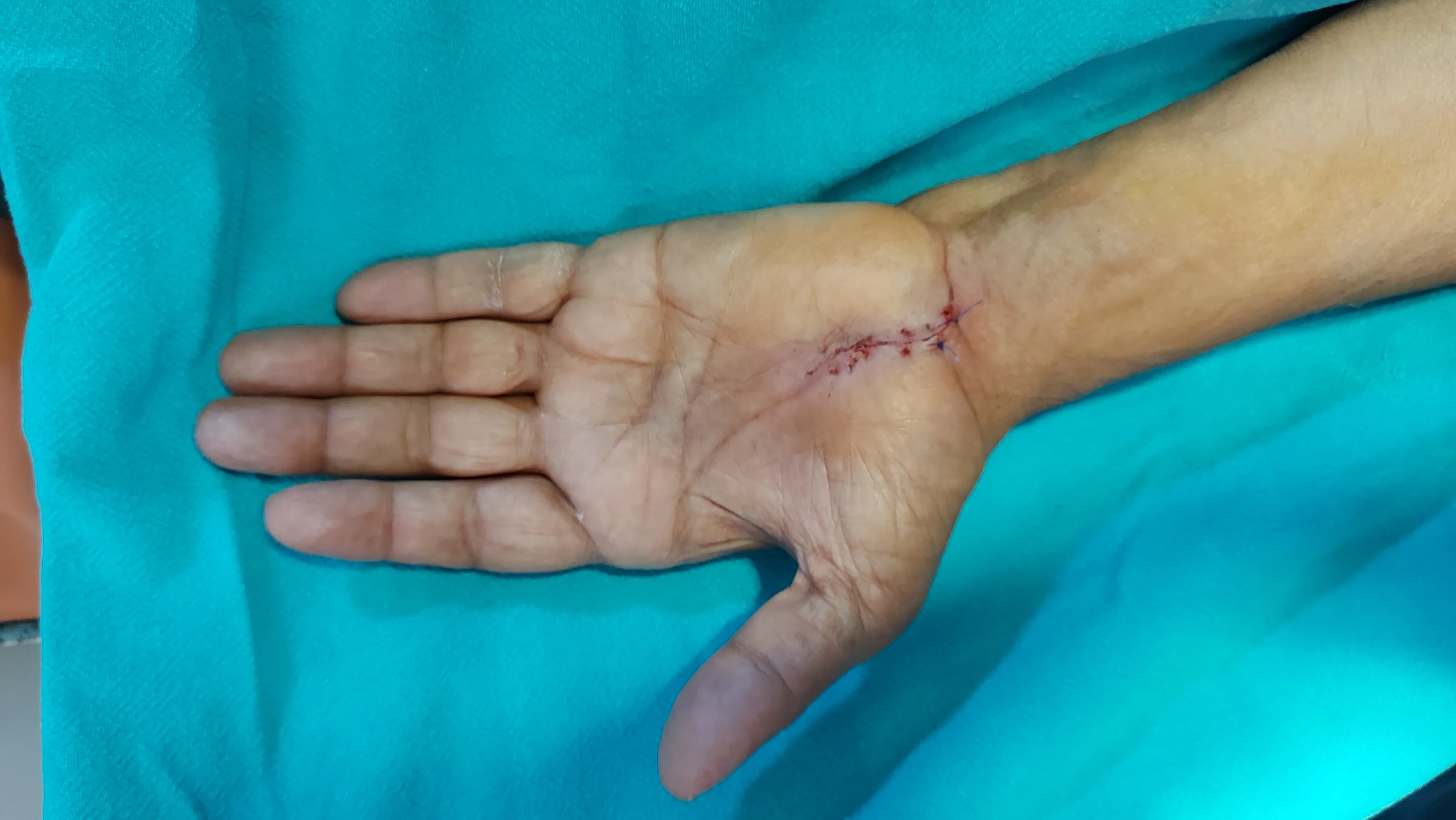 Carpal Tunnel Syndrome — after