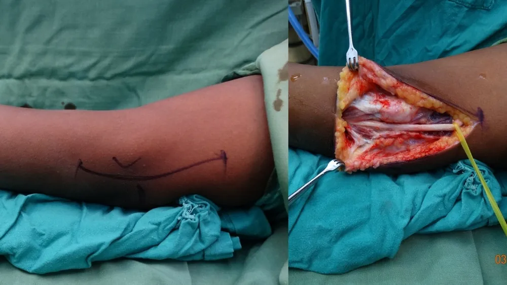 Cubital Tunnel Syndrome — before