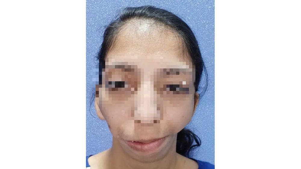 Bi Jaw Surgery — before