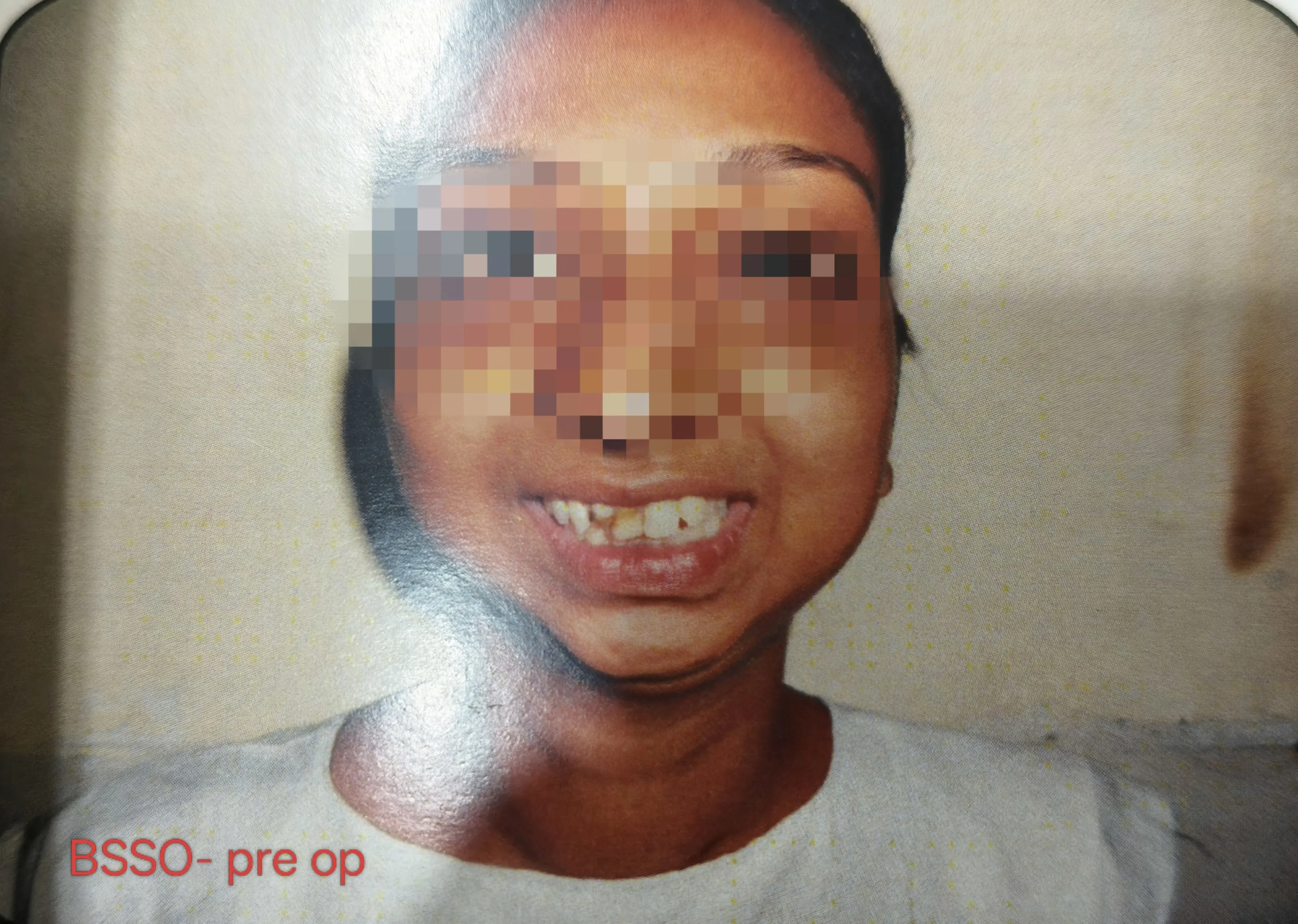 BSSO — before