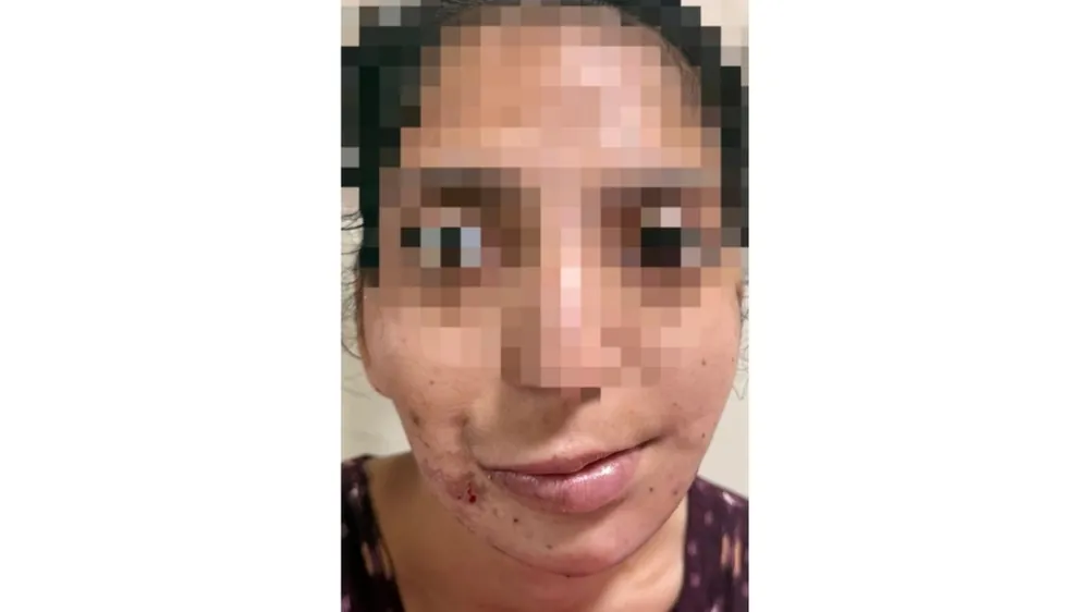 Craniofacial Microsomia — after