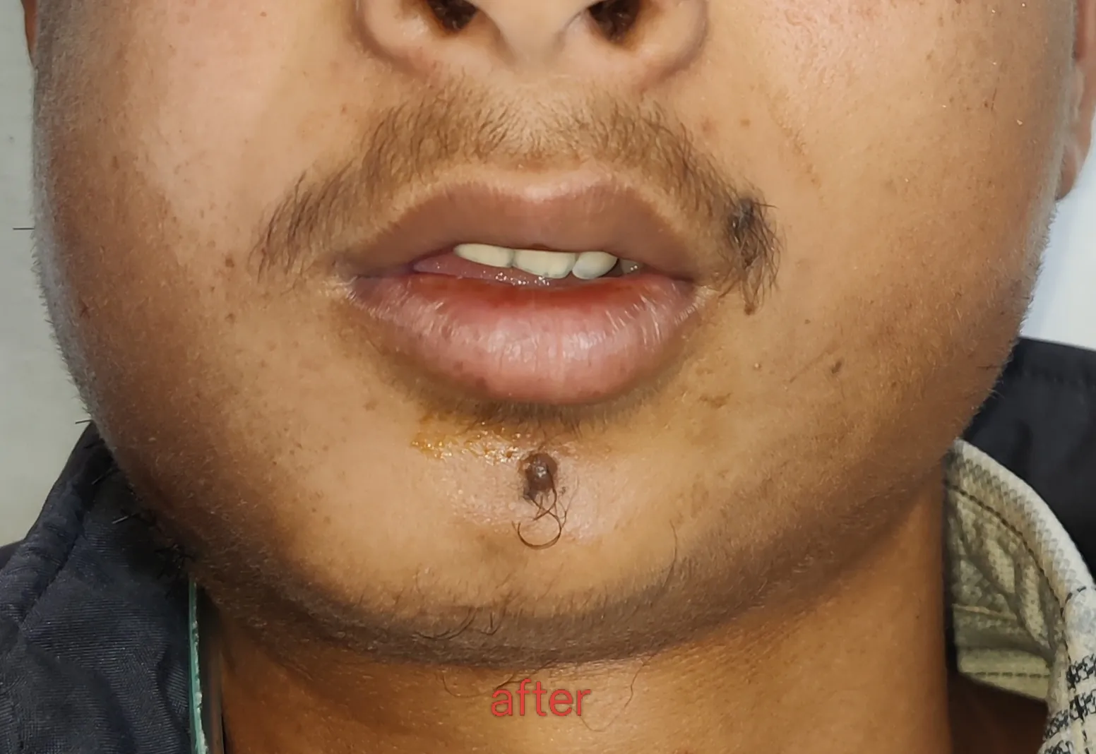 Craniofacial Microsomia — after