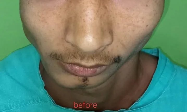 Craniofacial Microsomia — before