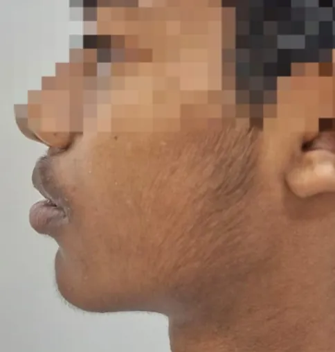 Lefort Osteotomy — after