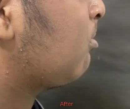 Lefort Osteotomy — after