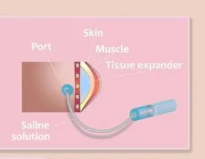 Tissue Expansion — hero image