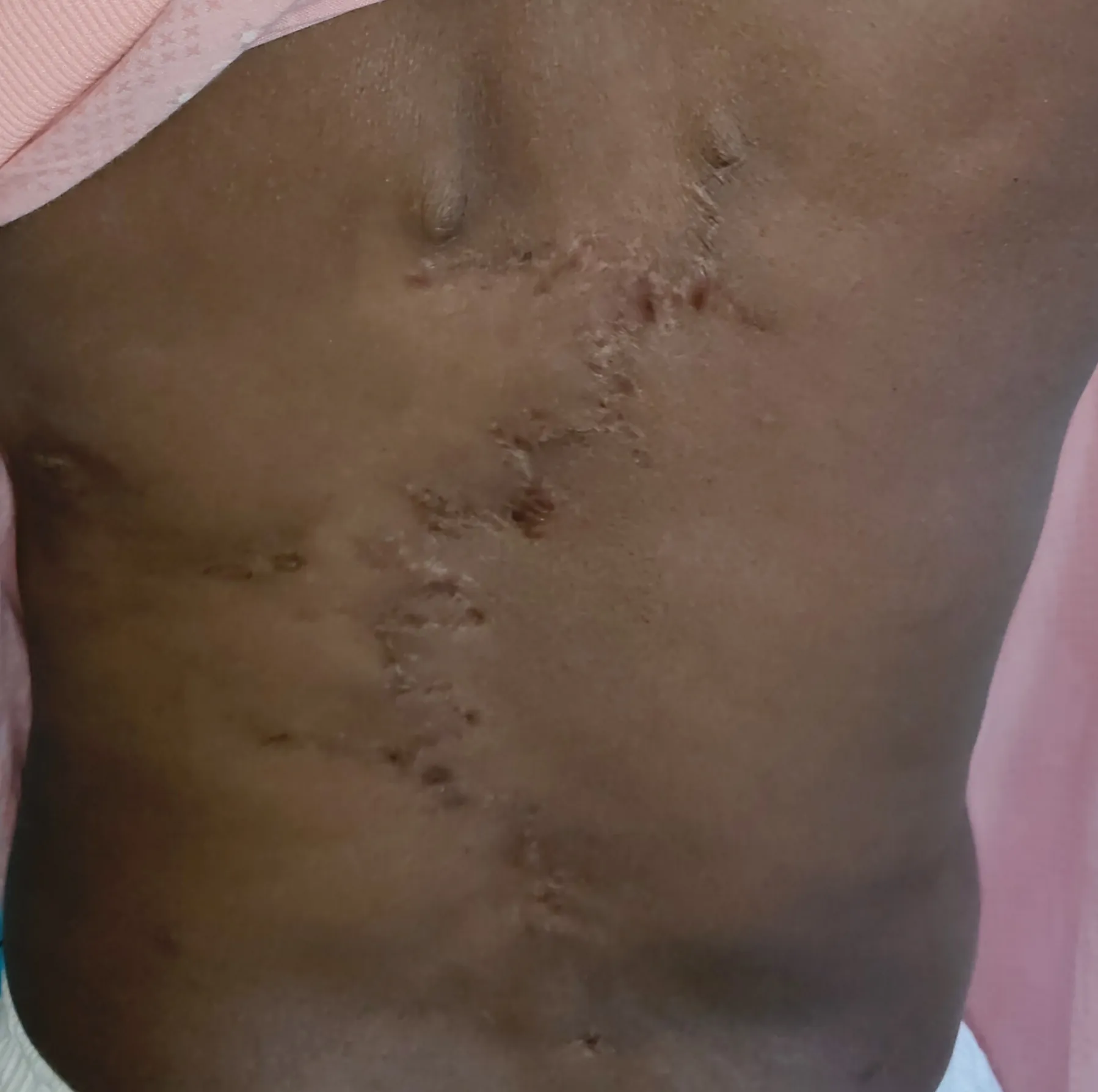 After surgery