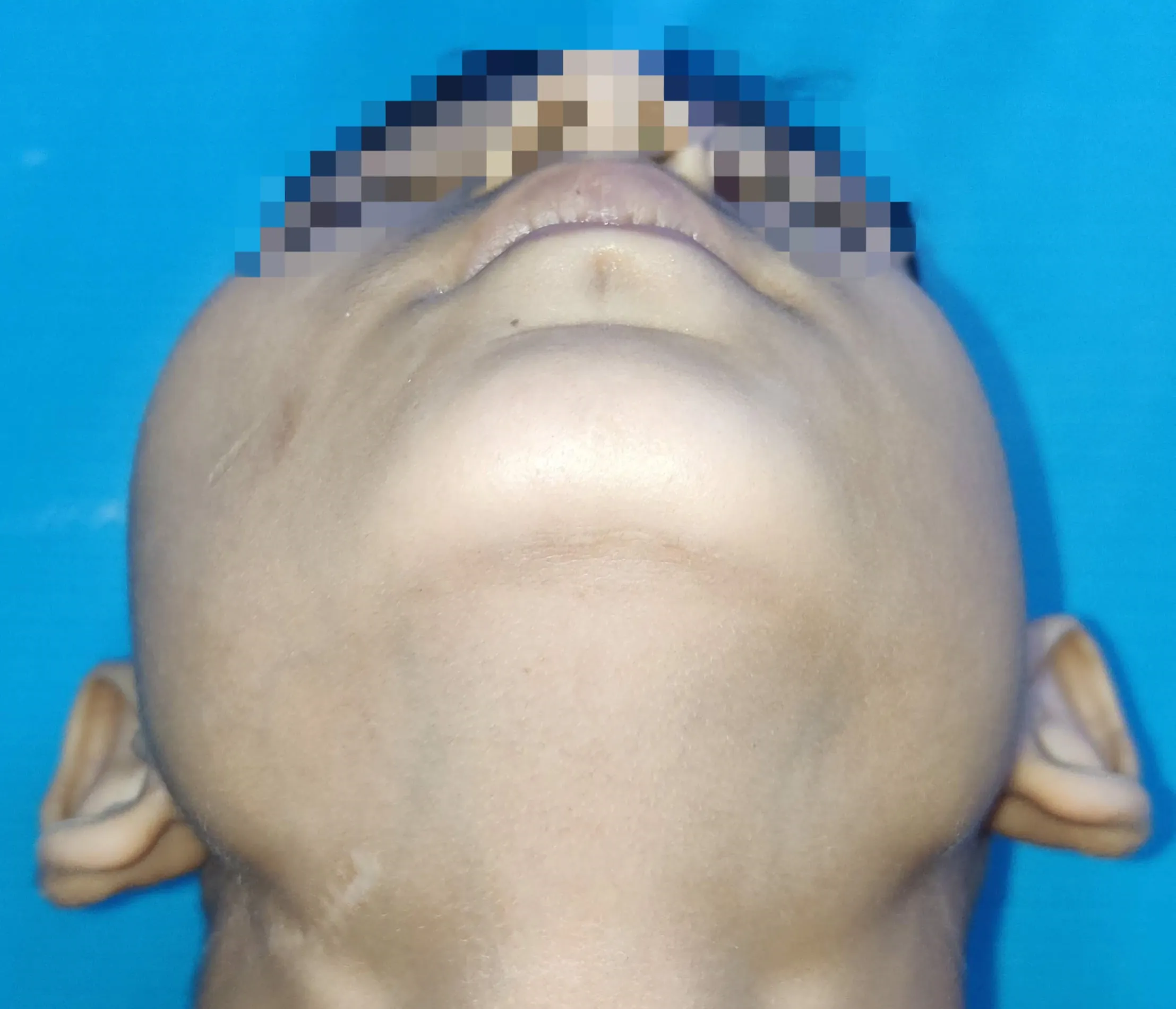 Haemangiomas — after