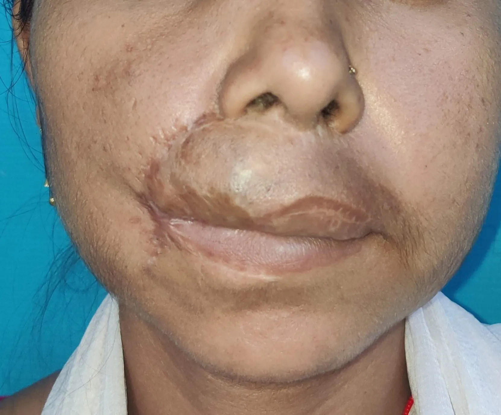 High Flow Malformations — after