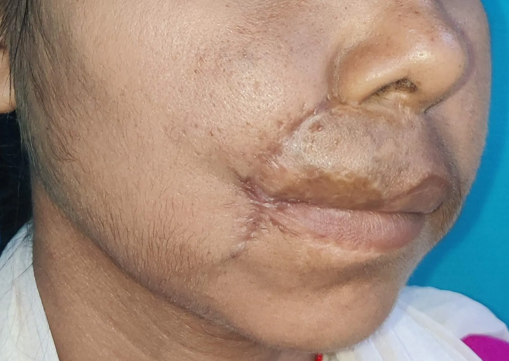 High Flow Malformations — after