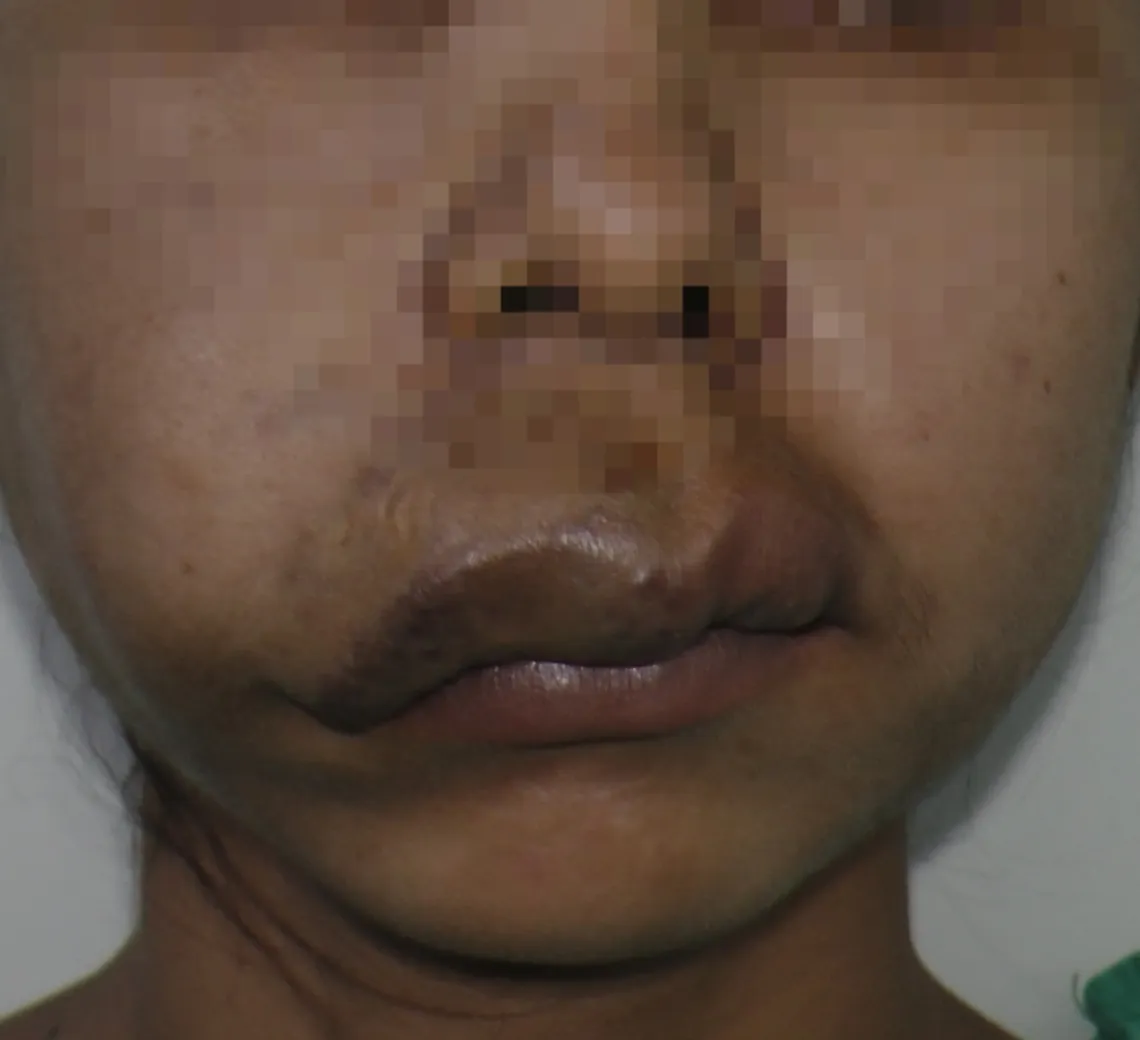 High Flow Malformations — before