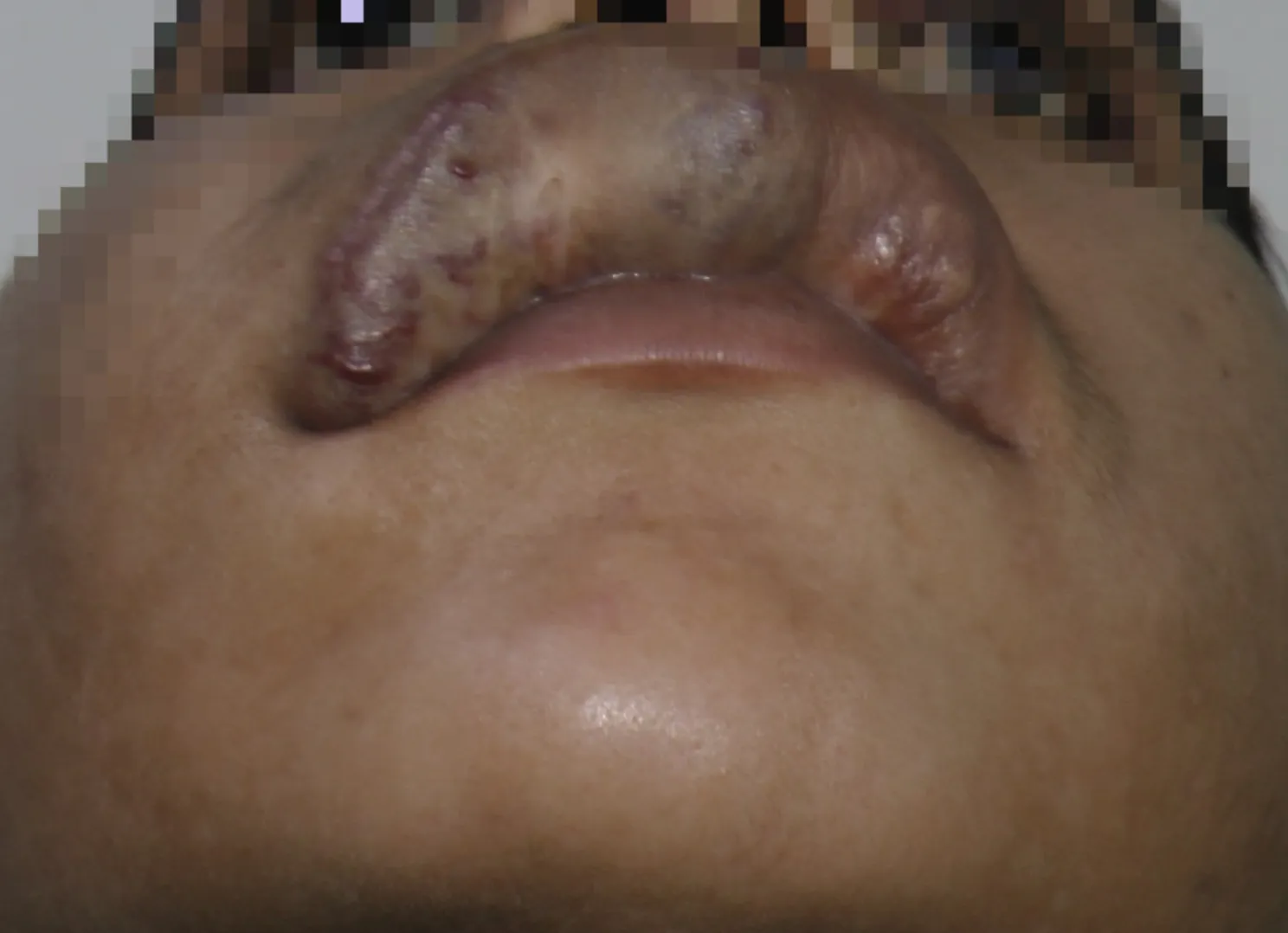 High Flow Malformations — before