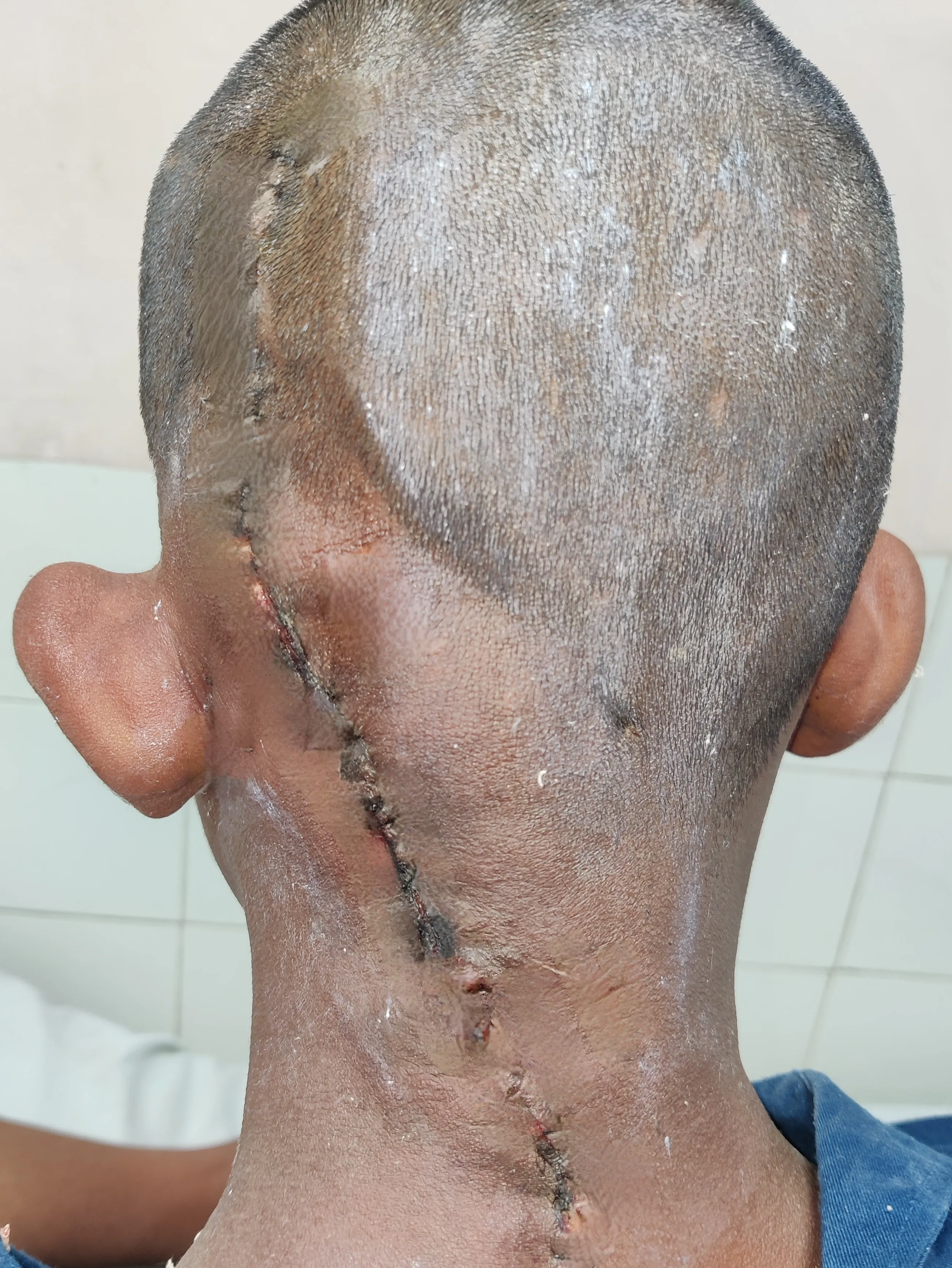 High Flow Malformations — after