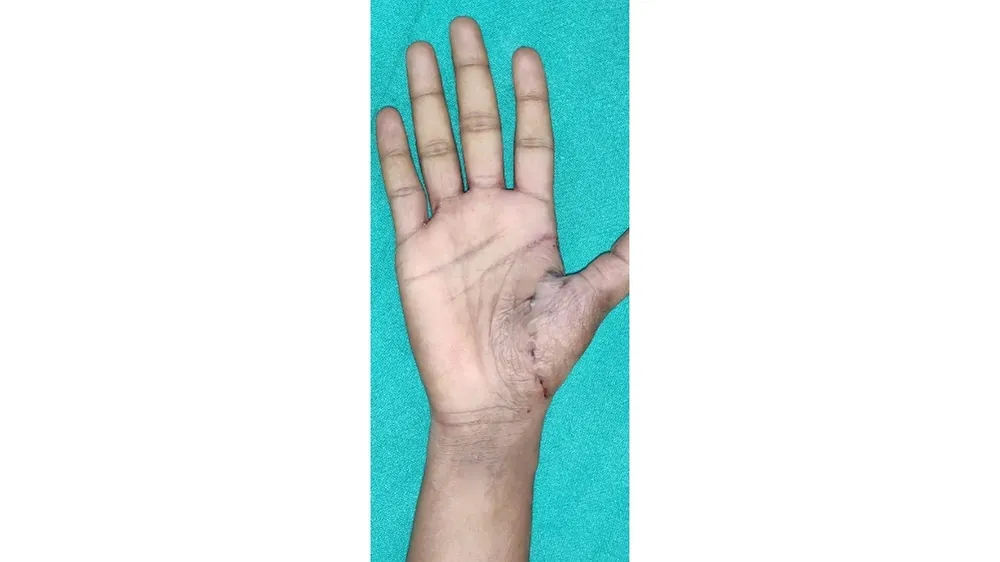 High Flow Malformations — after