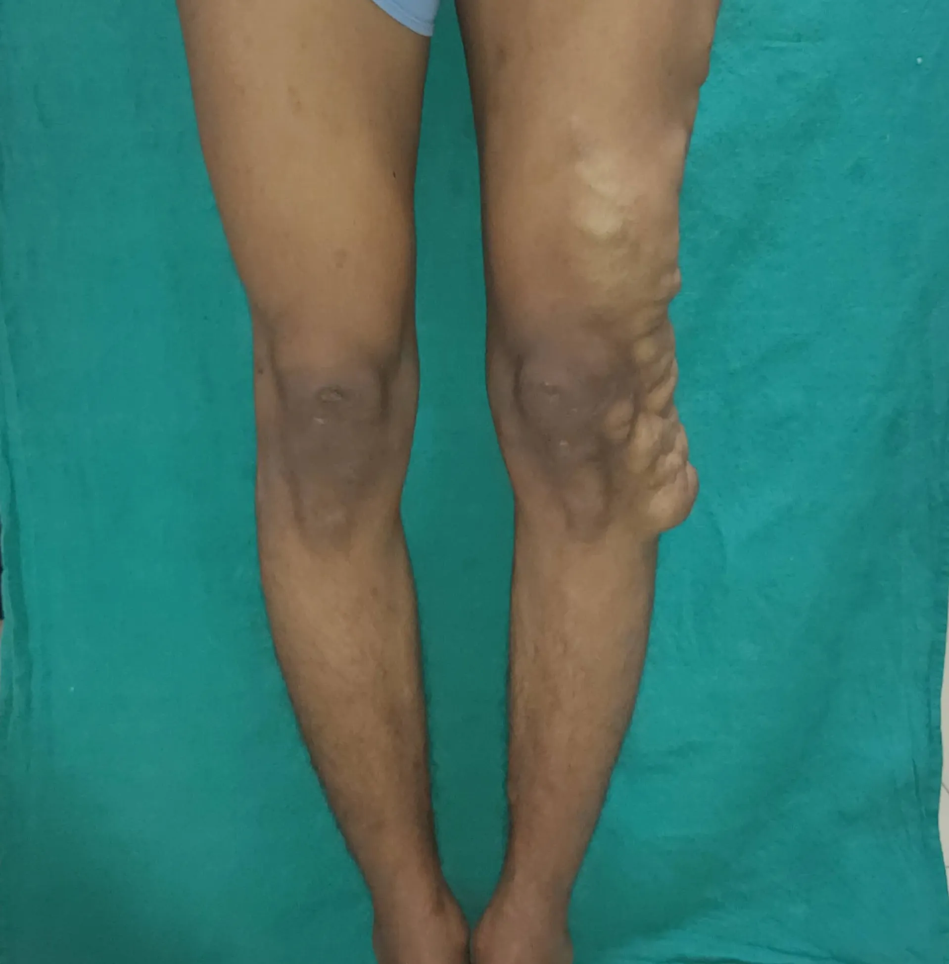 Low Flow Malformations — before