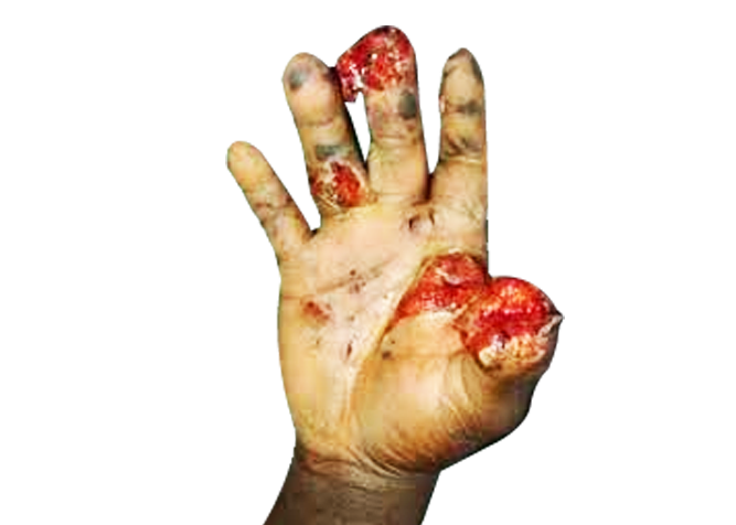 Blast/Cracker Injury Hand