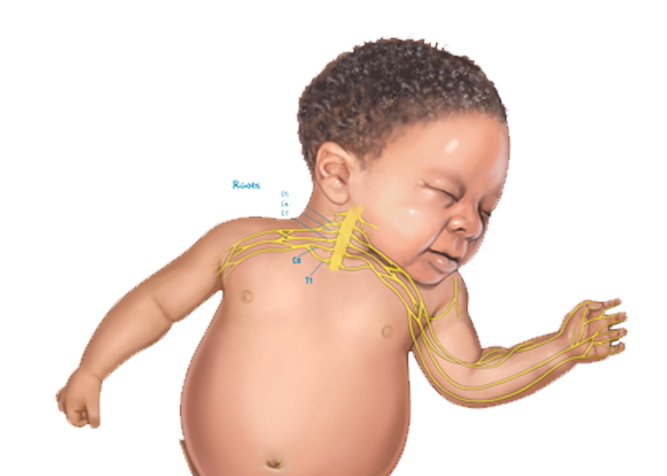 Brachial Plexus Injuries in Children